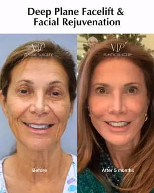 Deep Plane Facelift & Facial Rejuvenation