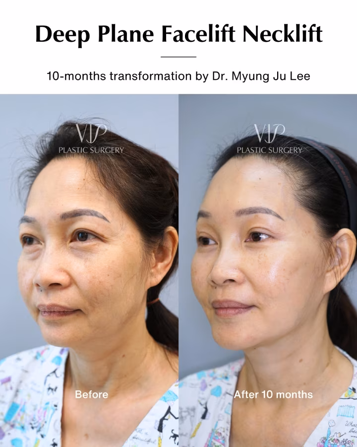 Deep Plane Facial Rejuvenation