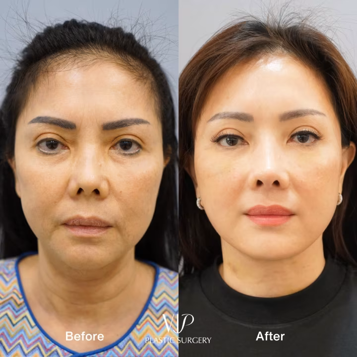 Deep Plane Facelift Necklift