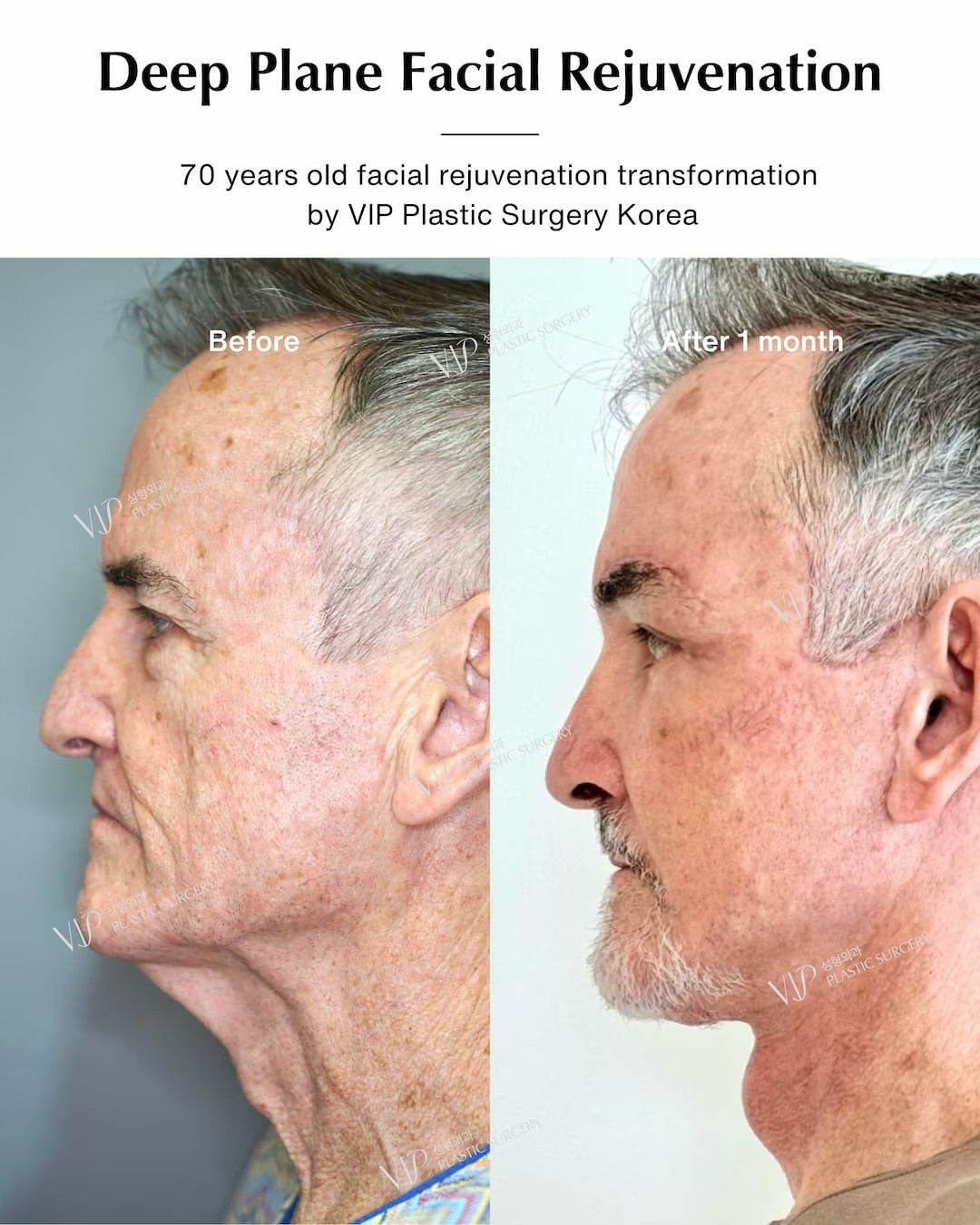 Deep Plane Facial Rejuvenation