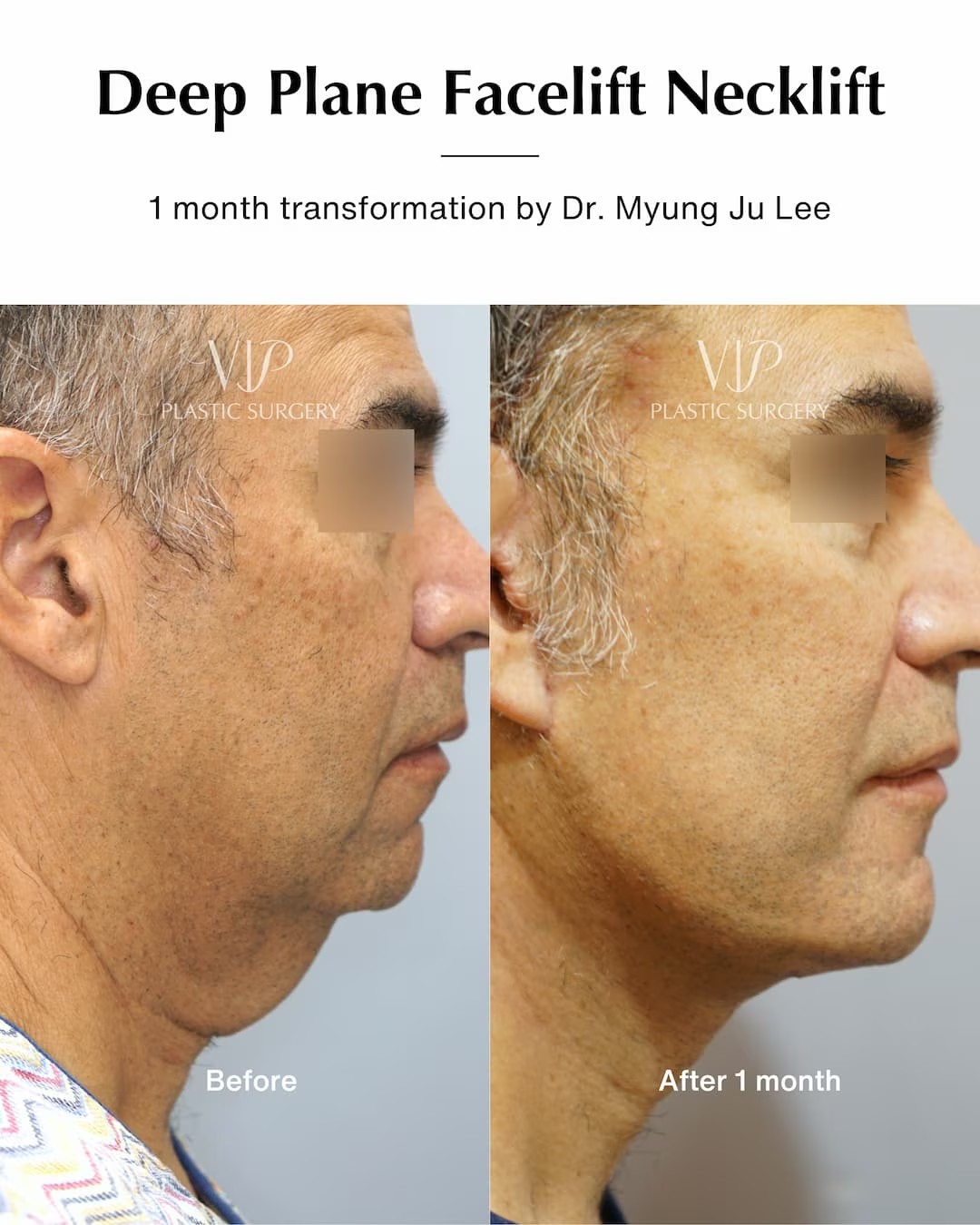 Deep Plane Facelift Necklift