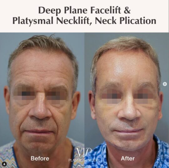 Male facelift before and after