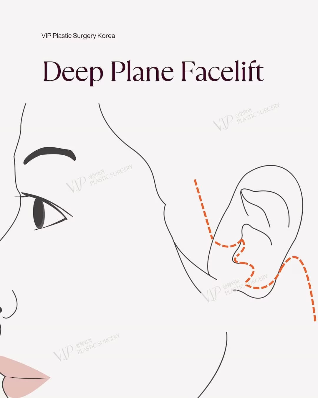 Deep Plane Facelift Incision Line