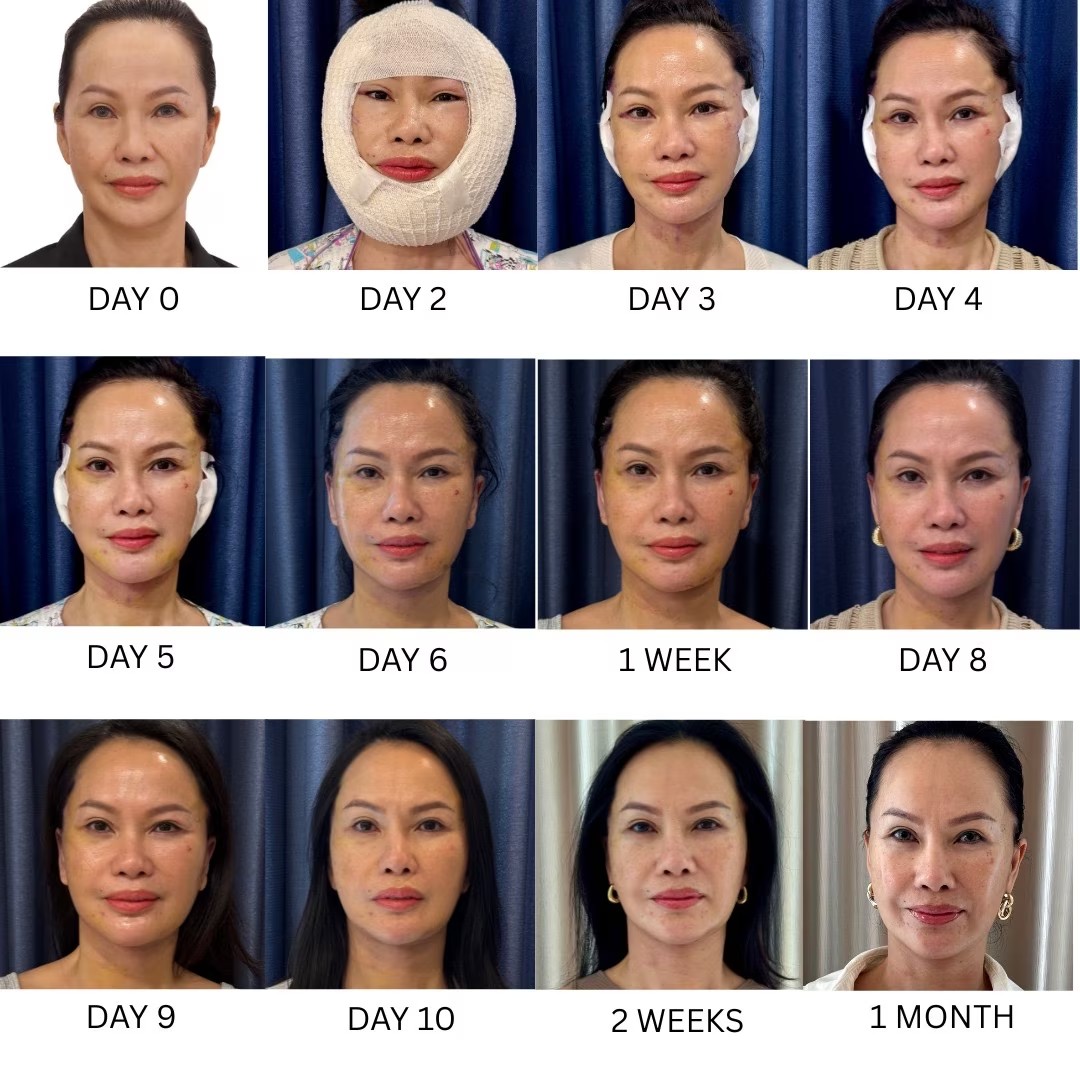 Facelift Recovery Timeline