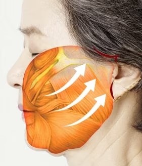 Step 02 - Extended Deep Plane Facelift