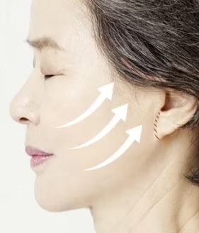 Step 03 - Extended Deep Plane Facelift
