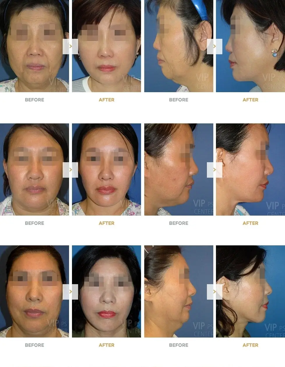 Real Facelift Results Before and After