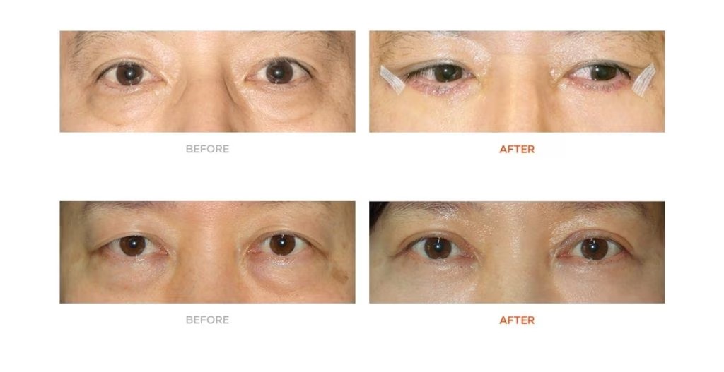Before & After