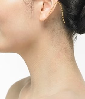 Neck Lift Step 01