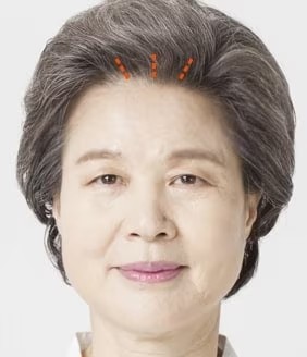 Endoscopic Forehead Step 01