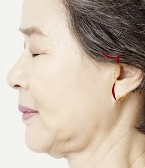 Mini Facelift Surgery Steps