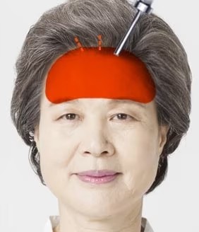 Endoscopic Forehead Step 02