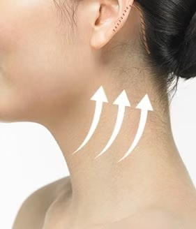 Neck Lift Step 03