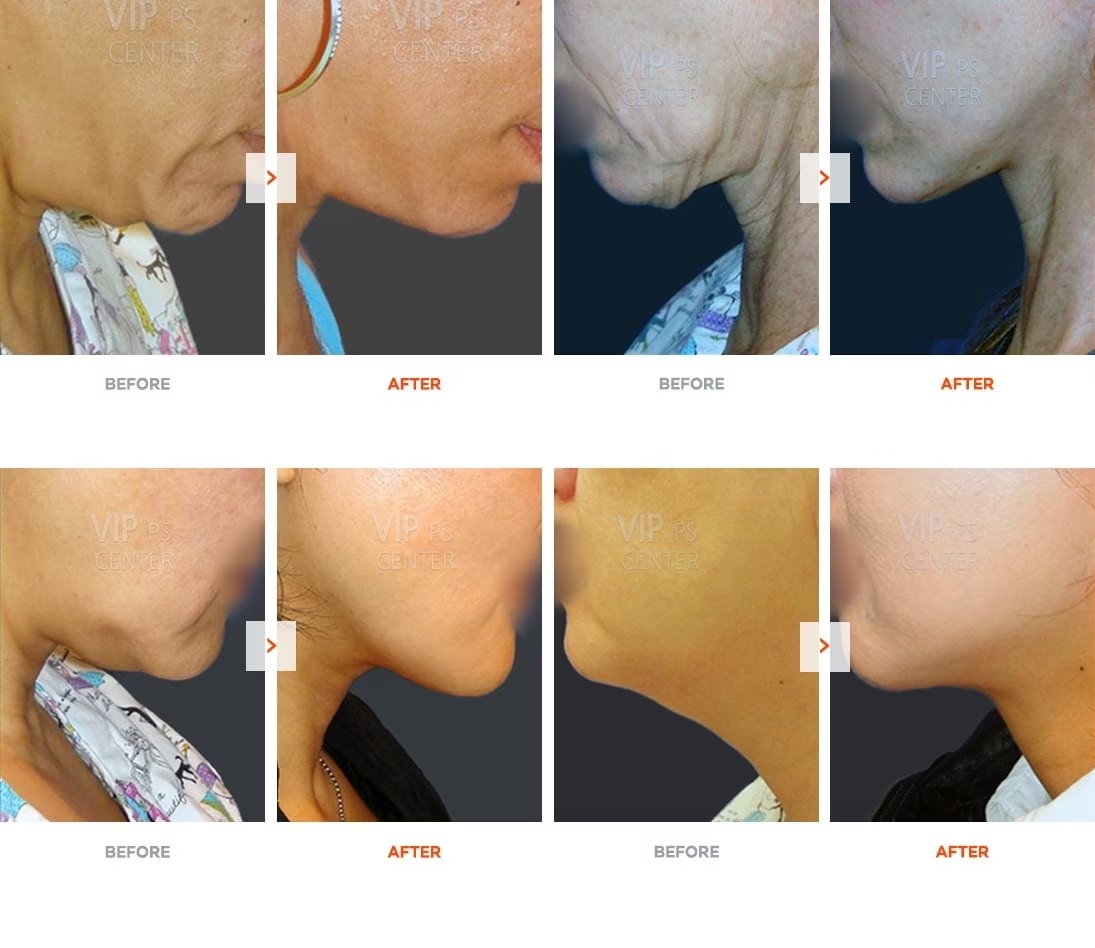 Neck Lift Before and After