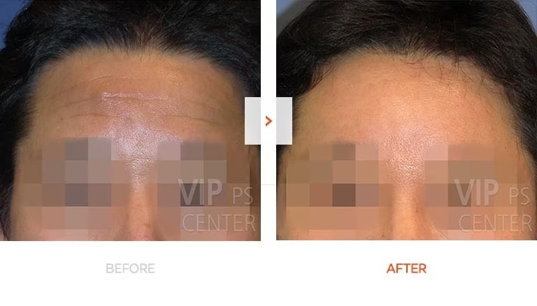 Endoscopic Forehead Before and After